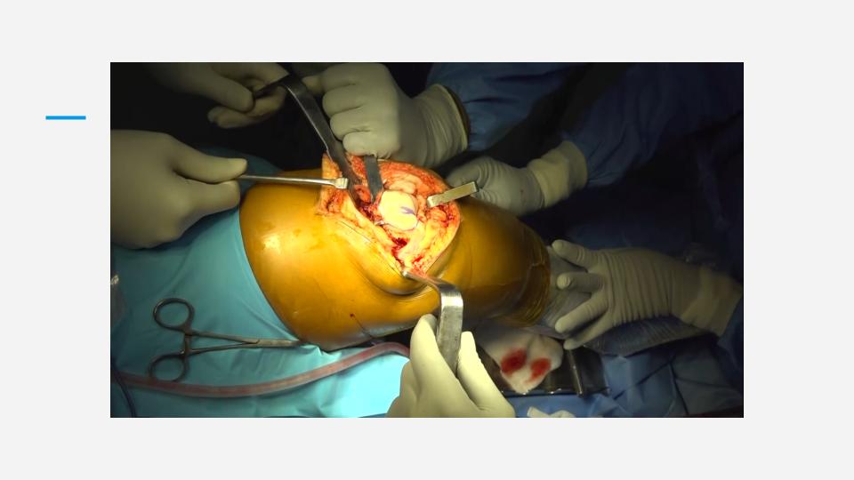 Surgery Trasmission (3)